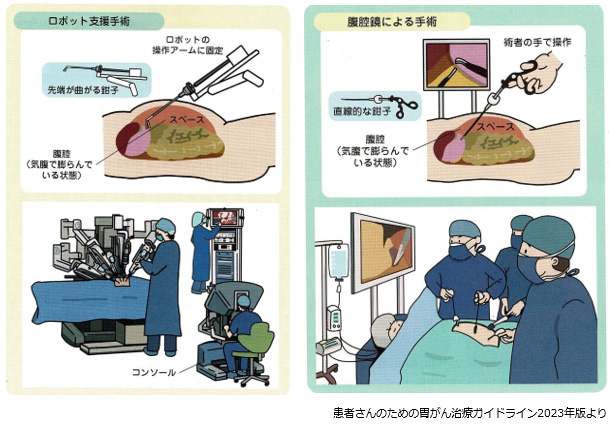 当院のロボット胃切除術の実績